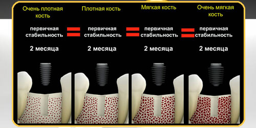 Имплантация по системе Any Ridge-имплатны 21 века!